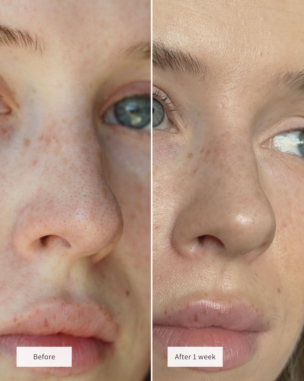 ClearPore Overnight Hydrocolloid Nose Patches